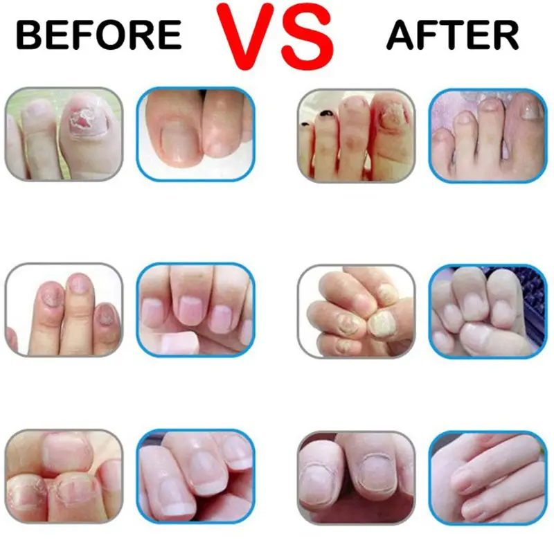 3ml Natural Herbal Toenail Fungus Nail Fungal Treatment Pen Nutrient Solution Feet Care Manicure Repair Gel Essence Tool | Красота и