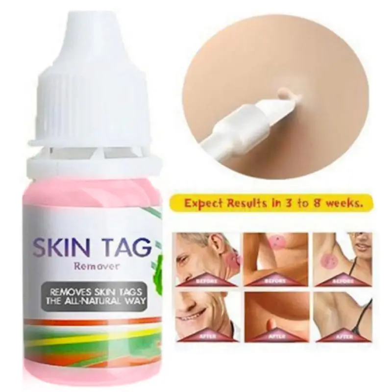 

10ml Skin Tag Remover Liquid Foot Corn Plantar Body Warts Treatment Ointment