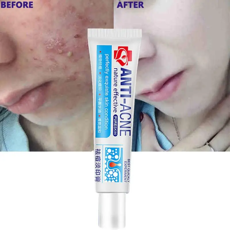 

30g Effective Anti-acne Cream Facial Acne Repair Fade Acne Marks Oil Control Shrink Pores Whitening Moisturizing Cream Skin Care