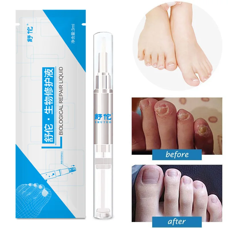 3ml Nail Fungus Treatment Liquid Anti Fungal Finger Toe Nails Care NShopping
