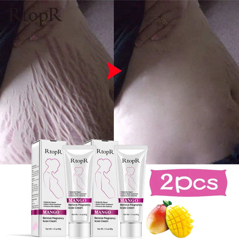 RtopR восстанавливающий крем для удаления шрамов беременных лечение акне против