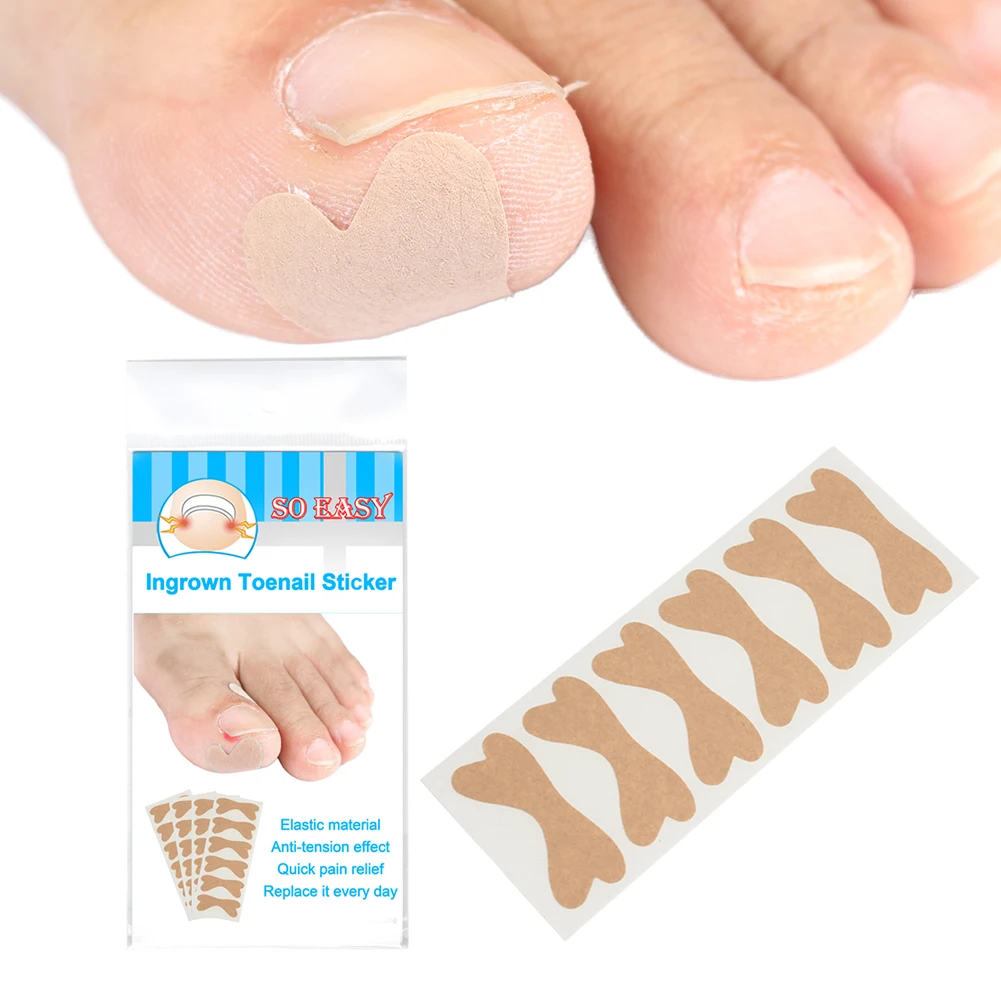 

Наклейка для коррекции ногтей, корректор для педикюра, наклейка для коррекции вросших пальцев ногтей, корректор, корректор, уход за ногами