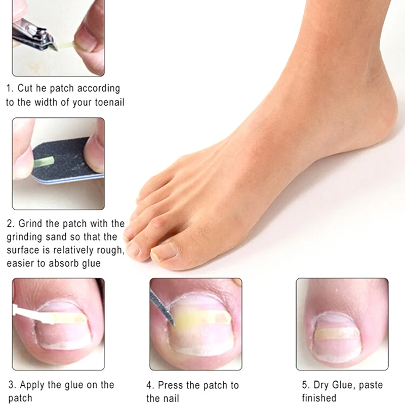 Новый 1 набор для коррекции вросших ногтей лечения пилка выпрямитель толкатель