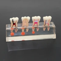dental teeth model 4 stage endodontic treatment clear demonstrates model for study teaching clinic decoration