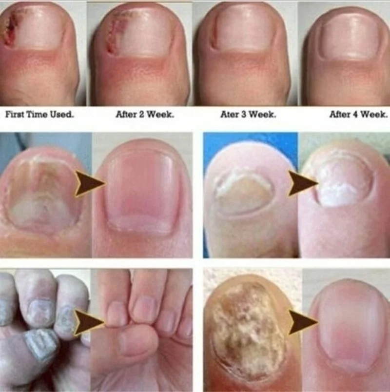 

10ml/5ml/3ml Nail Repair Liquid Nail Fungus Removal Anti Onychomycosis Feet Care Treatment With Foot File Nail Repair Liquid