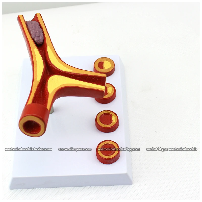 12482/модель крови для атеросклероза и тромбоза/CMAM медицинская анатомическая