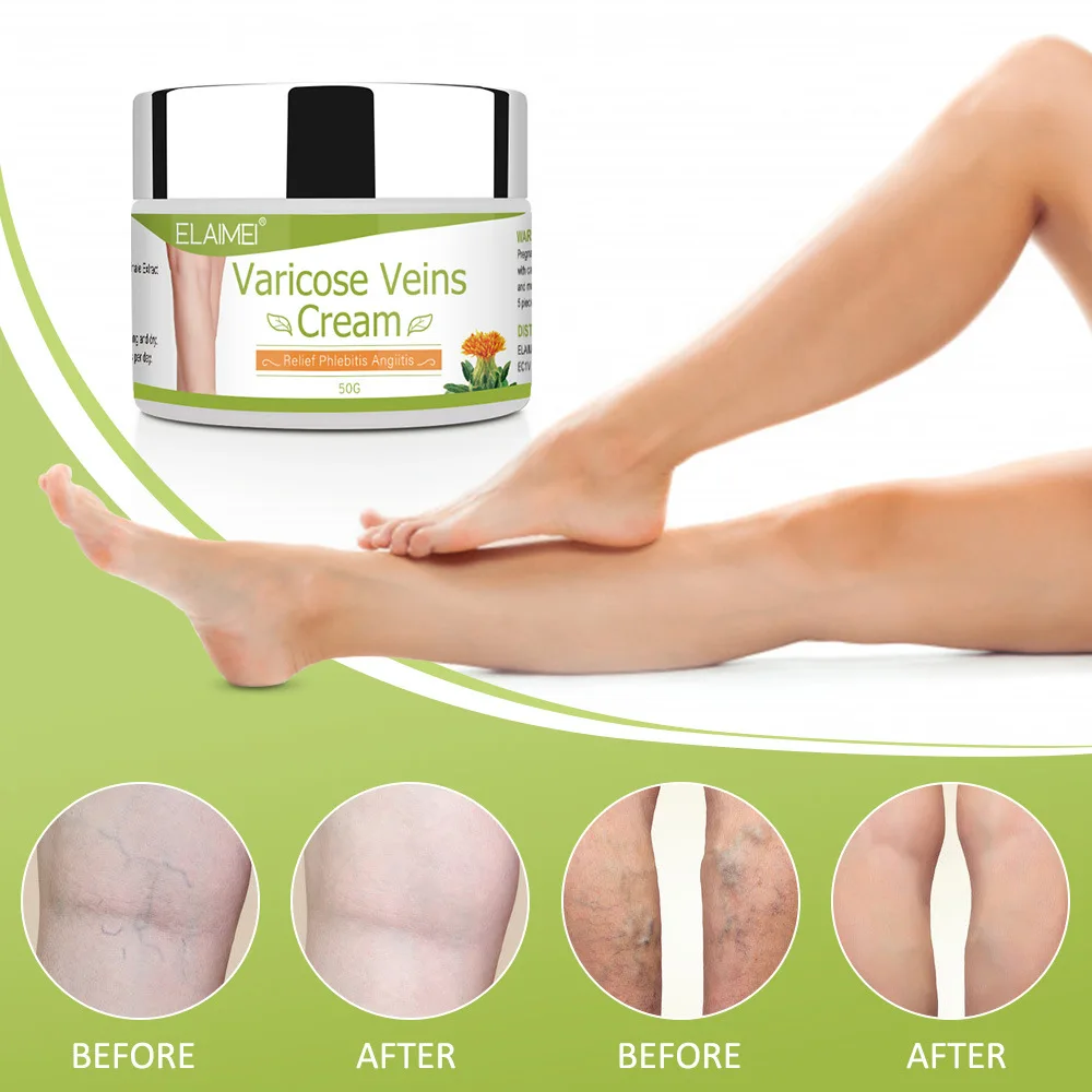 

Varicose Veins Treatment Cream Effective cure Vasculitis Phlebitis Spider Veins Pain Varicosity Angiitis ointment Health Care