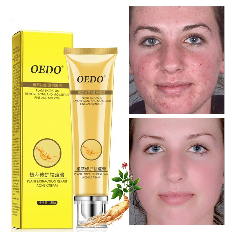 

Plant Extraction Repair Acne Cream Ginseng Scutellariae Extract Face Care Acne Treatment Skin Care Facial Cream Whitening 20g