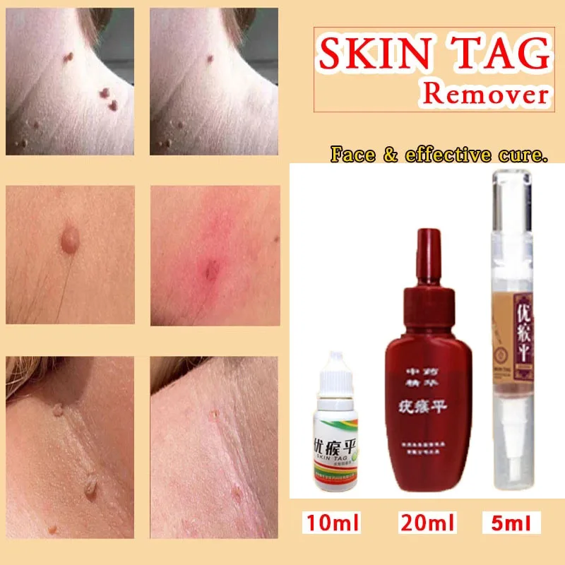 

Skin Tag Remover 12 hours Medical fast Removal Mole & Genital Wart Foot Corn Treatment Kit skin Care Anti Wart Bacteriostatic
