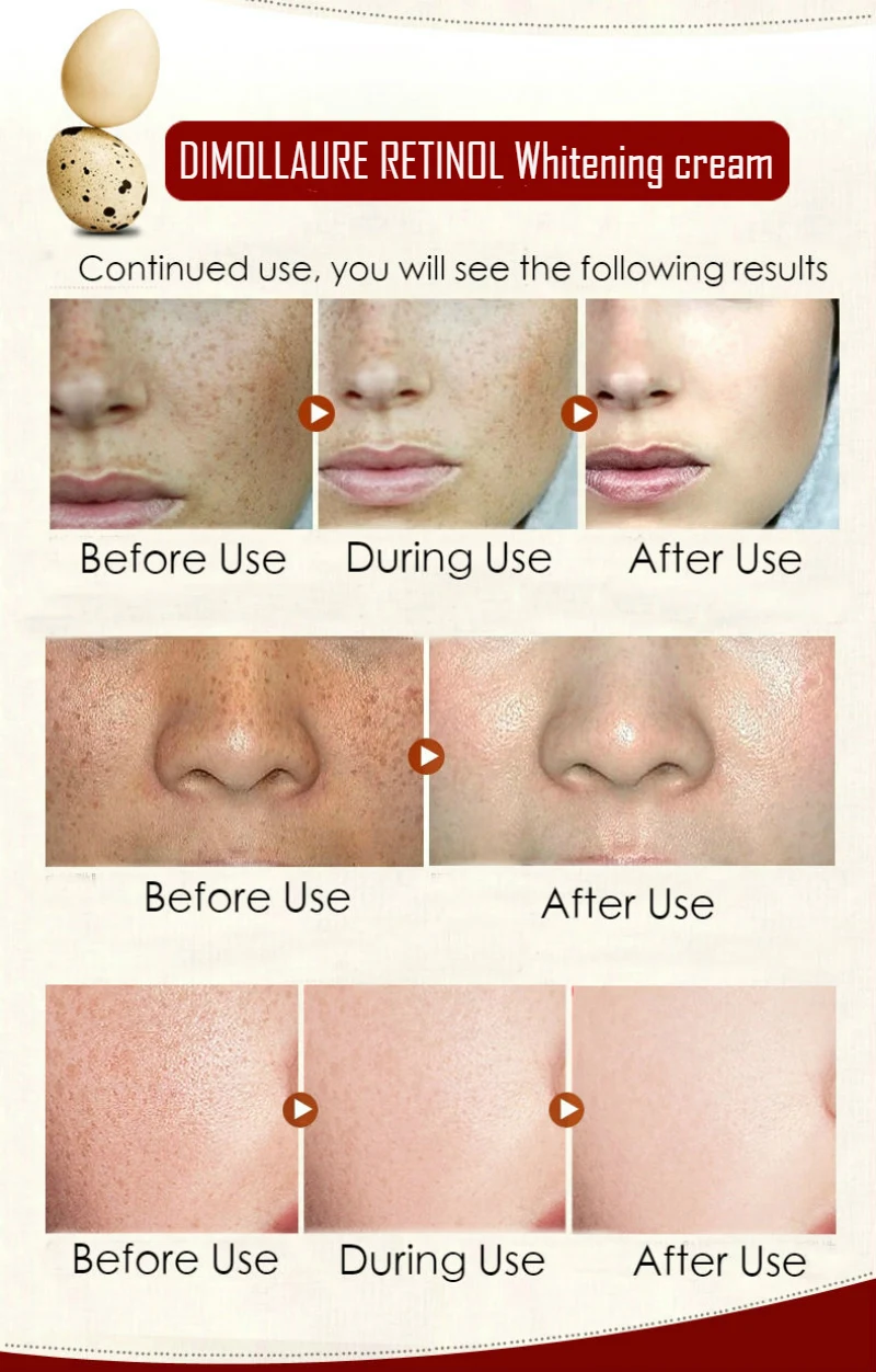 Dimollaure Retinol cream Vitamin C peptides serum whitening acne treament Remove Freckle melasma Melanin dark Spots | Красота и