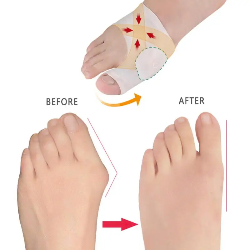 

Big toe overlap Silicone Hallux Valgus Corrector Toe Separators Bunion Correctors Foot Finger Splitter toe protection orthosis