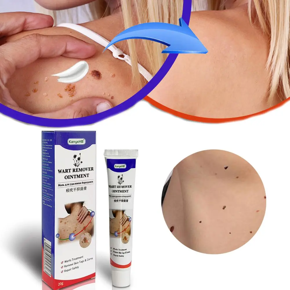 

Neck Skin Tag Beauty & Health Feet Corns Wart Removal Ointment Wart Treatment Cream Wart Cream Flat Wart Genitals