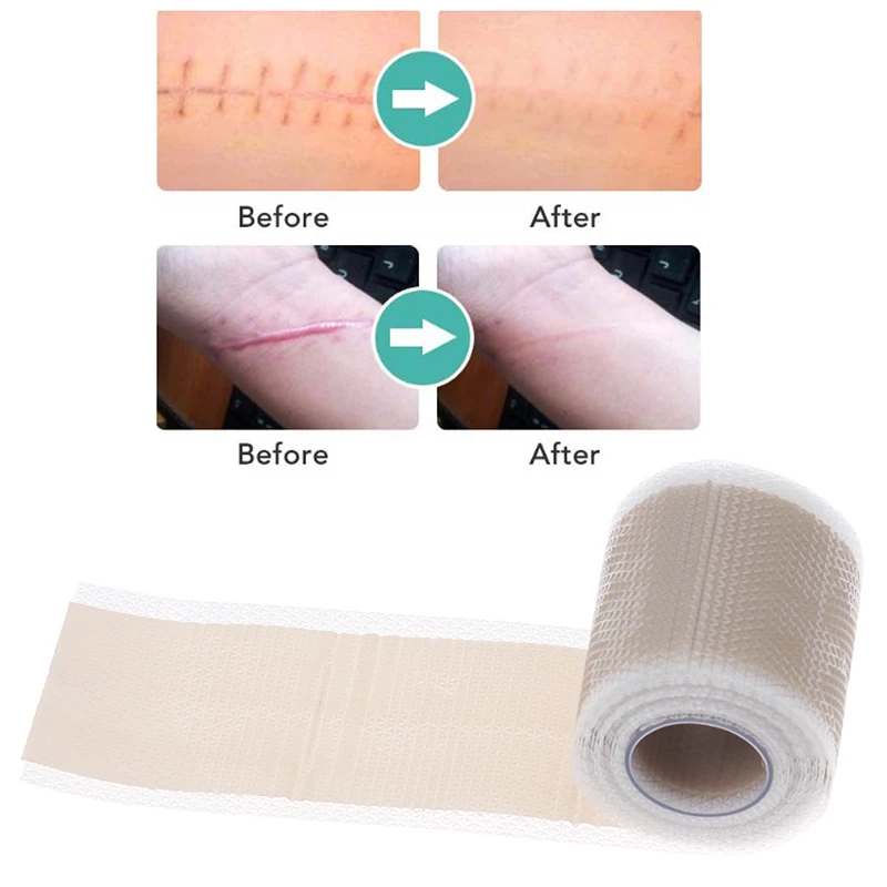 Эффективное удаление шрамов от акне 4 м|Брекеты и подставки| |