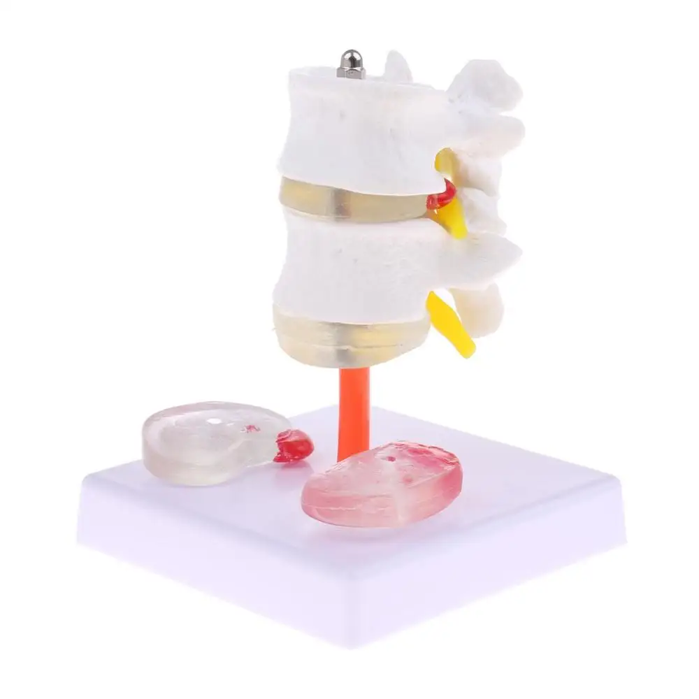 Медицинский Скелет с двумя поясничными позвонками и больным межпозвоночным