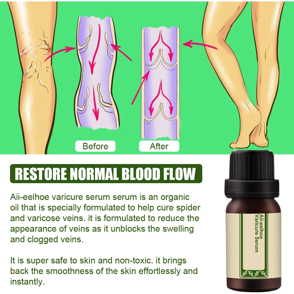 

All-10/30ml Natural Vari-Cure Serum All-eelhoe Varicose Vein Treatment for Treatment Legs Care Personal Health Care P9