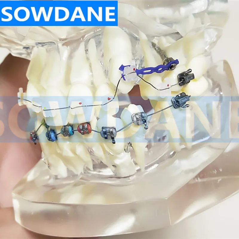 Прозрачная Стоматологическая Ортодонтическая модель для прикуса с двумя видами