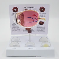 cataracts enlarged pathological eyeball demonstration teaching aids ophthalmology model classroom supplies