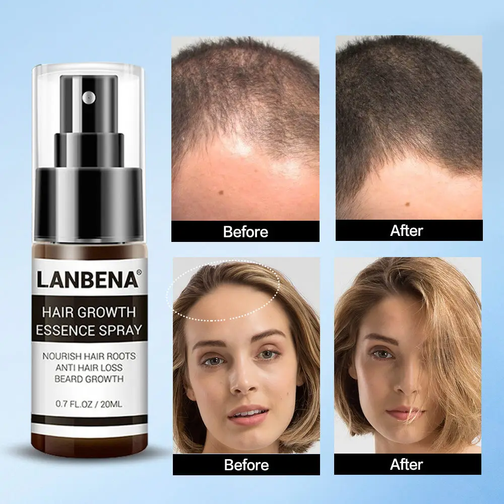 Спрей для роста волос эфирное масло быстрого лечение против выпадения утолщение