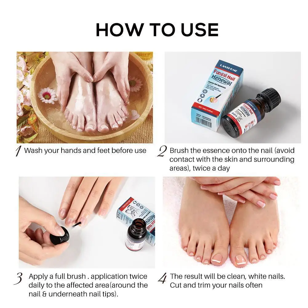 

LANBENA Fungal Nail Repair Essence Serum Anti Infection Gel Care Treatment Removal Nail Onychomycosis Foot Paronychia Fungu N7D5