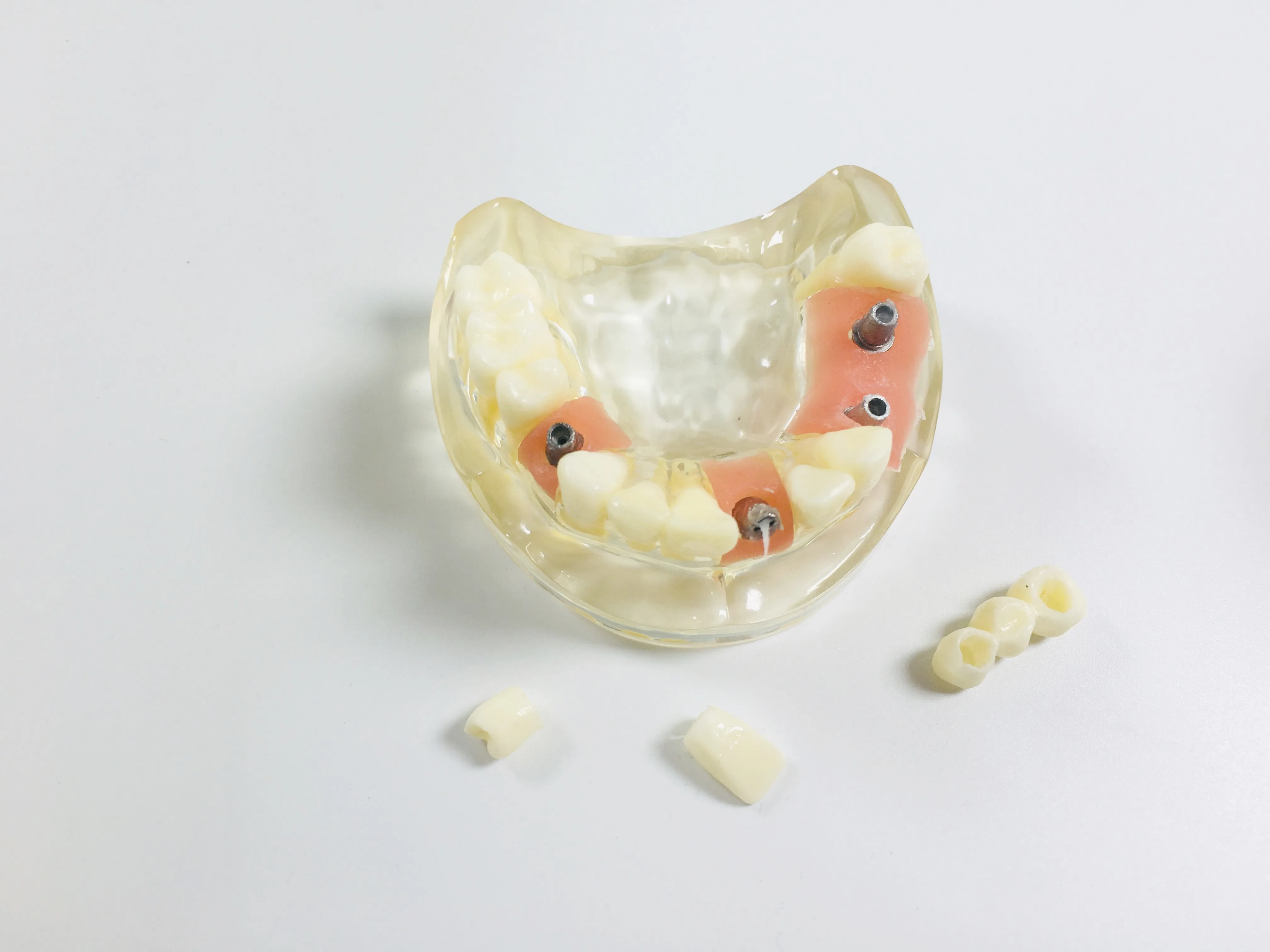 

2X Dental Implant Upper half Teeth Practise Model With Soft Gum & Bridge Crowns