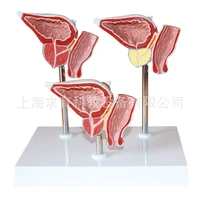 3pcsset normal prostate benign prostatic hypertrophy bph with or without symptoms and cancer model medical supplies