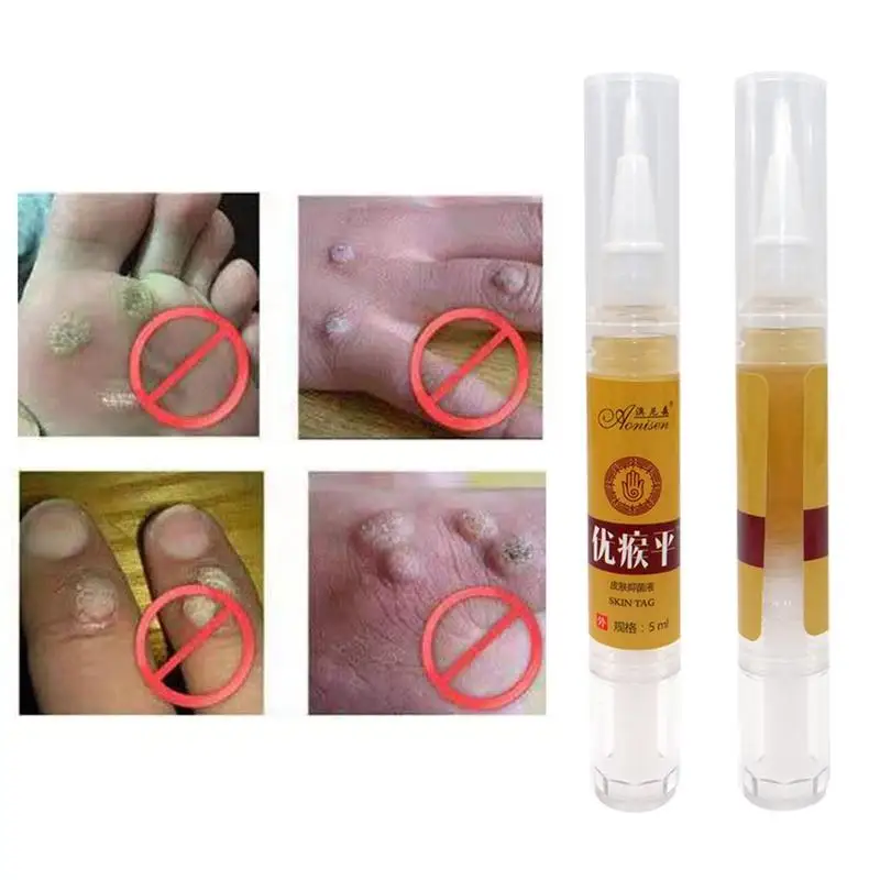 

Skin Tag Remover Pen 12 hours Tu kill Medical Remover Skin Tag Mole & Genital Wart Remover Foot Corn Removal Pen