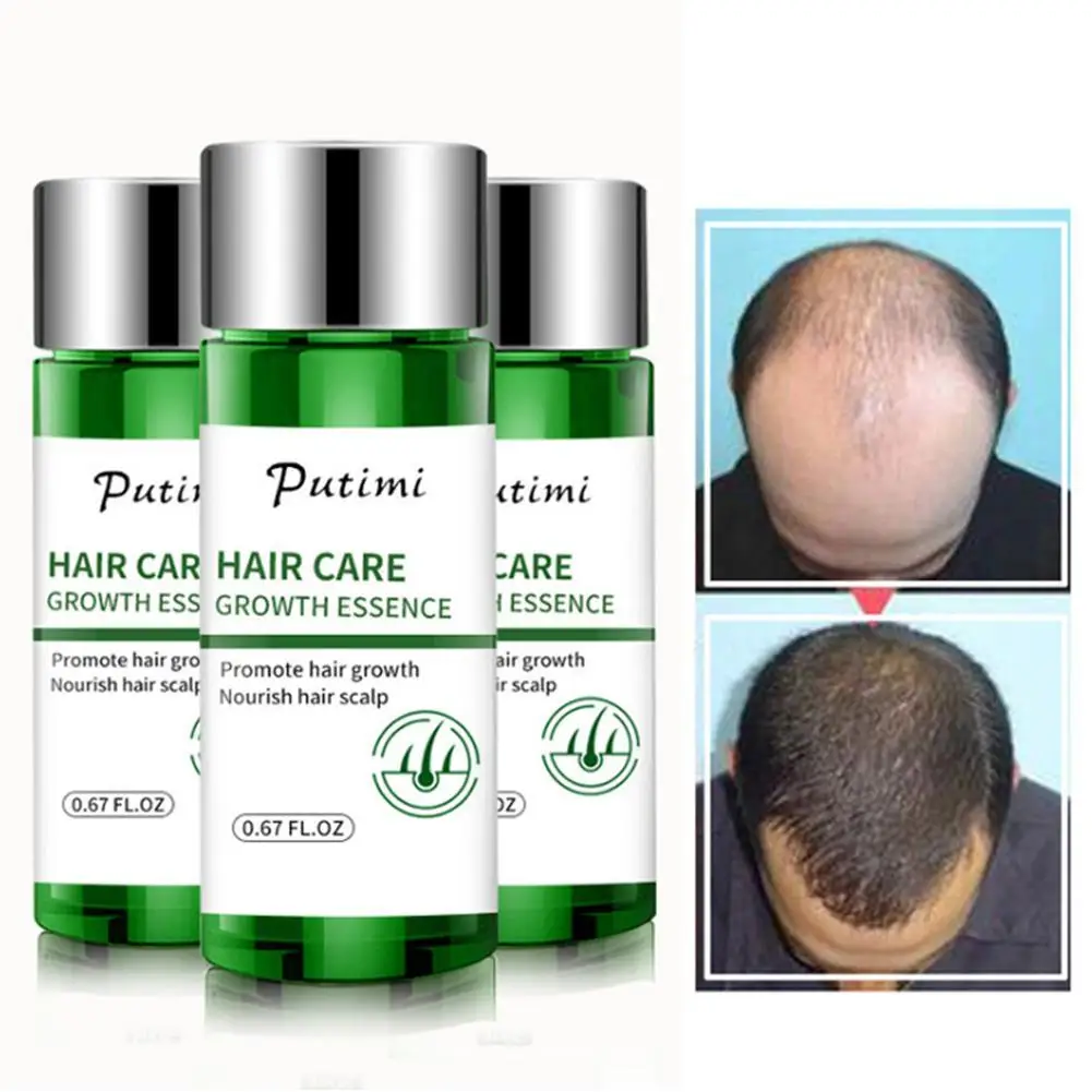 

Ginger Hair Growth Essential Oils Promote Hair Regrowth Essence Prevent Baldness Hair Loss Hair Serum Repair Damaged Hair Care