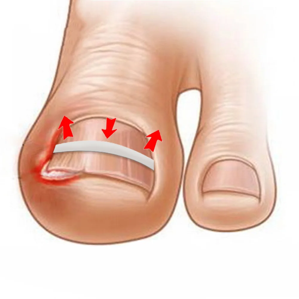 Зажим для выпрямления вросших ногтей изогнутый пластырь BS Brace набор инструментов