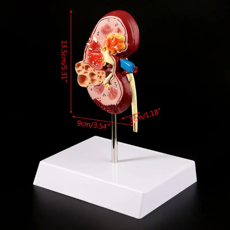 

Life Size Human Kidney Diseased Model Anatomical Anatomy Diseased Pathological Stone Organ Teaching Supplies 20CB