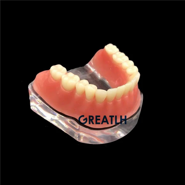 Overdenture implant model Denture Teeth mandibular with golden bar Dental Teaching Model | Красота и здоровье