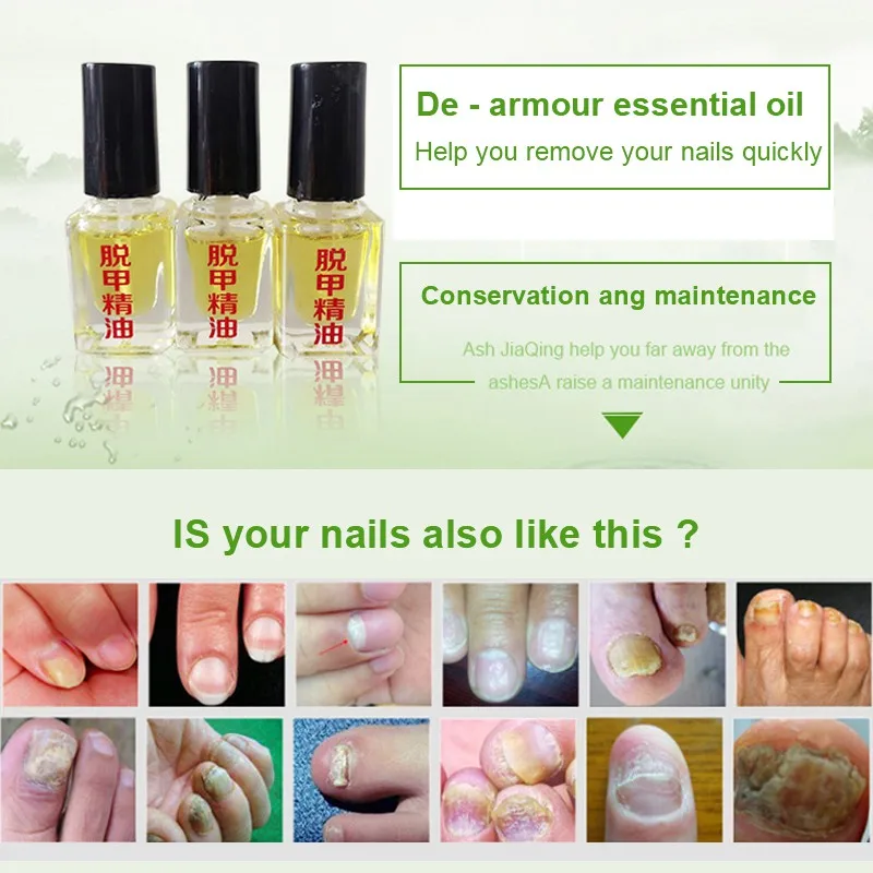 Лечение ногтей Удаление онихомикоза паронихия против жира бактерицидная