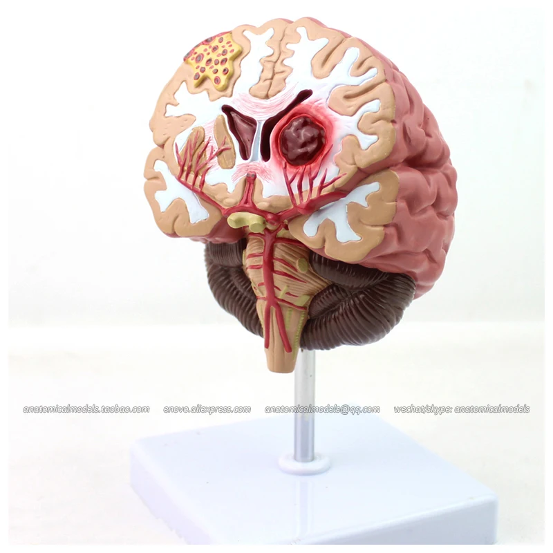 CMAM/12408 патология мозга медицинская анатомическая человеческая модель