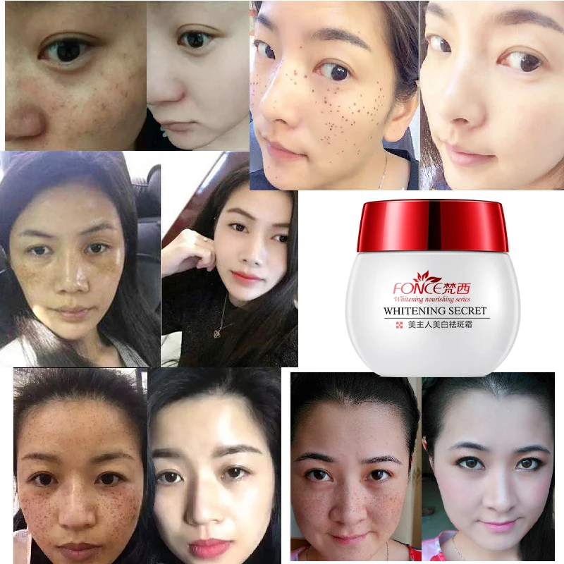 Korean Remove Freckles Cream 30g Skin Whitening Strong Effect Spot Remover Reduces Age Spots Fade Dark Spot Treatment Stain Buy At The Price Of 21 26 In Aliexpress Com Imall Com