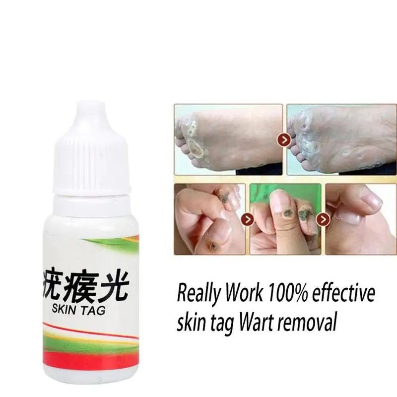 10 мл кожу средство удаления бирок моль женских половых органов для бородавок