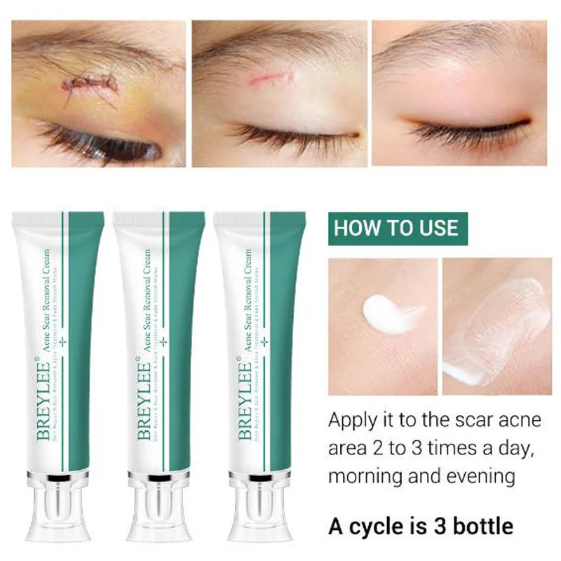 BREYLEE Scar Removal Cream Skin Care Face For Acne Stretch Remove Maternity Treatment Repair | Красота и здоровье