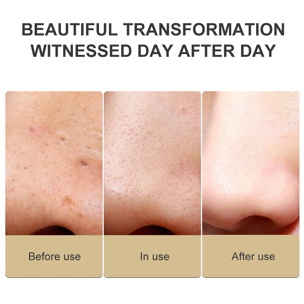 Электрический вакуумный очиститель для лица устройство удаления черных точек