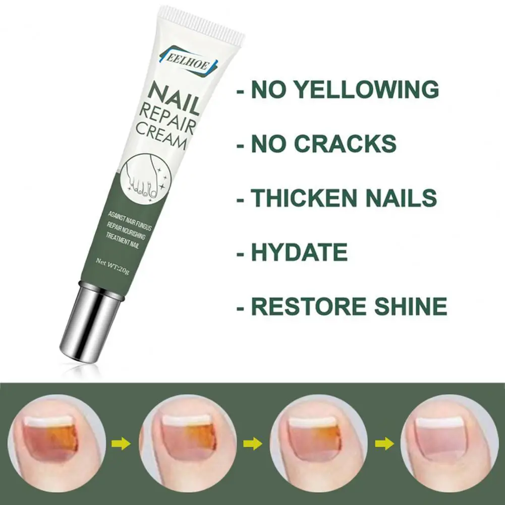

Healthy 20g/Bottle Useful Nail Fungus Repair Treatment Gel Long Lifespan Fungal Nail Treatment Painless for Household