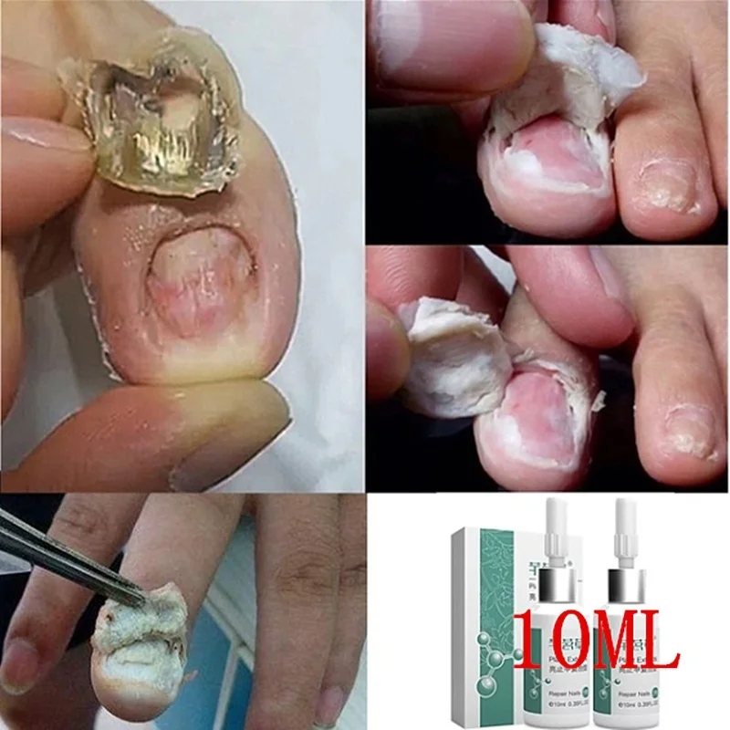 Средство для лечения грибка ногтей 3/5/10 мл средство онихомикоза паронихия