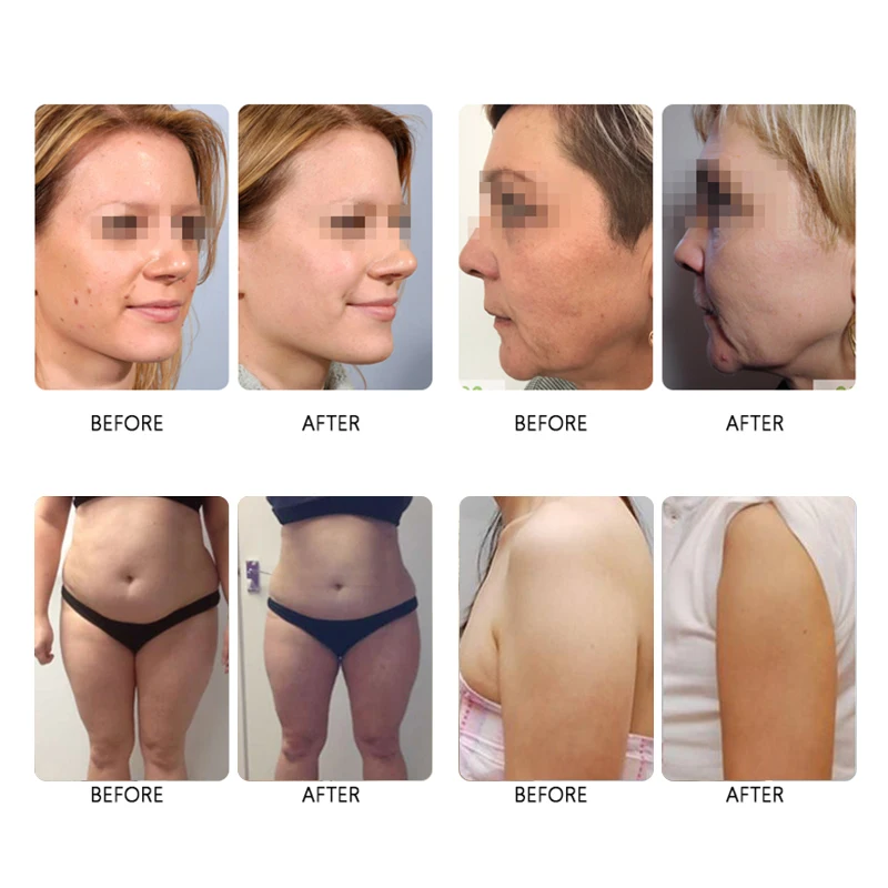 

3in1 4d hifu with vaginal tightening and face wrinkle