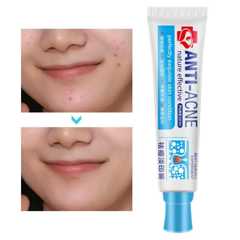 30mlAcne лечение уменьшает поры пятна гель для отбеливания отбеливающие кремы