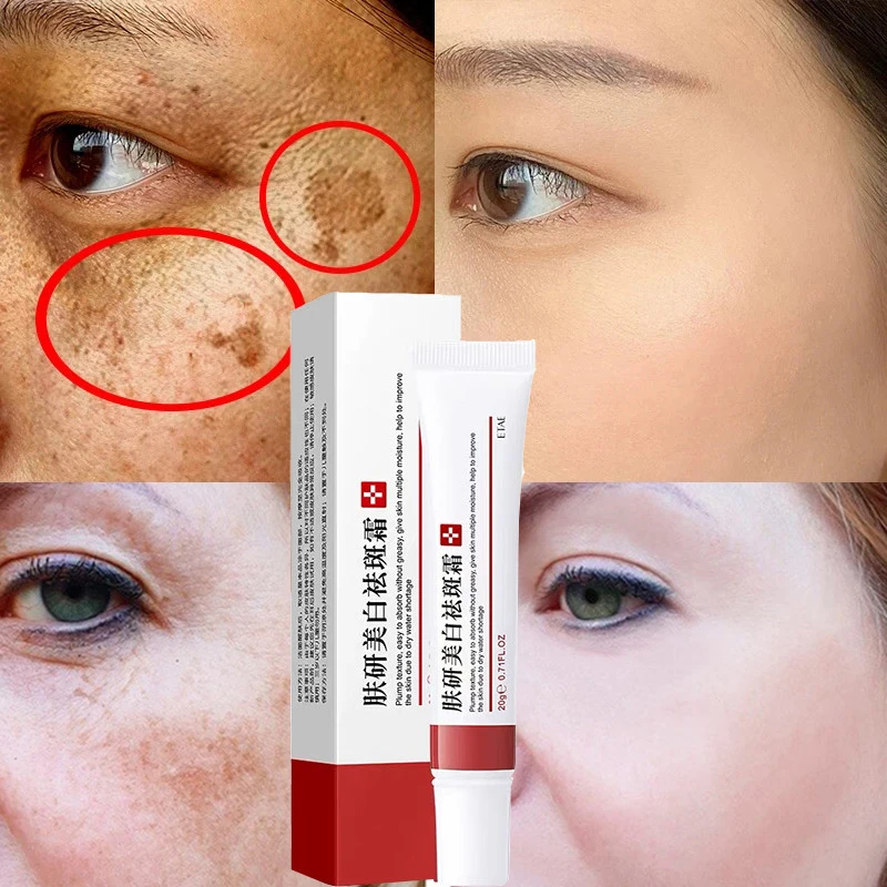 

Freckle Cream Remove Dark Spots Whitening Cream Fade Acne Scars Brighten Melanin Pigmentation Melasma Anti-Aging Whiten Skin 20g