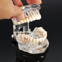 dental restoration teeth model transparent implant disedental implant disease teeth model with restoration bridge tooth dentist
