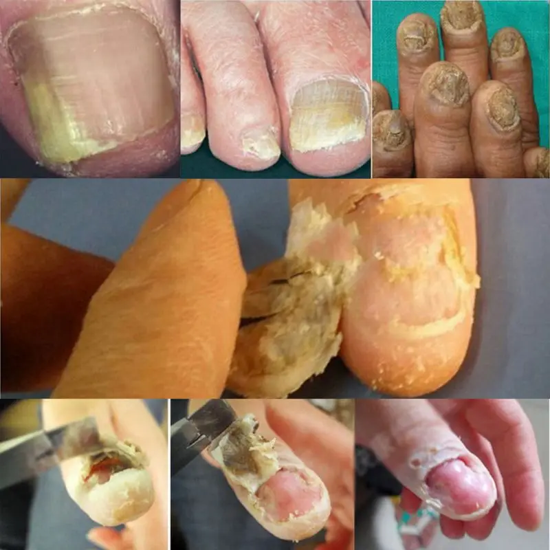 Противогрибковая эссенция из трав для лечения грибка ногтей | Красота и здоровье