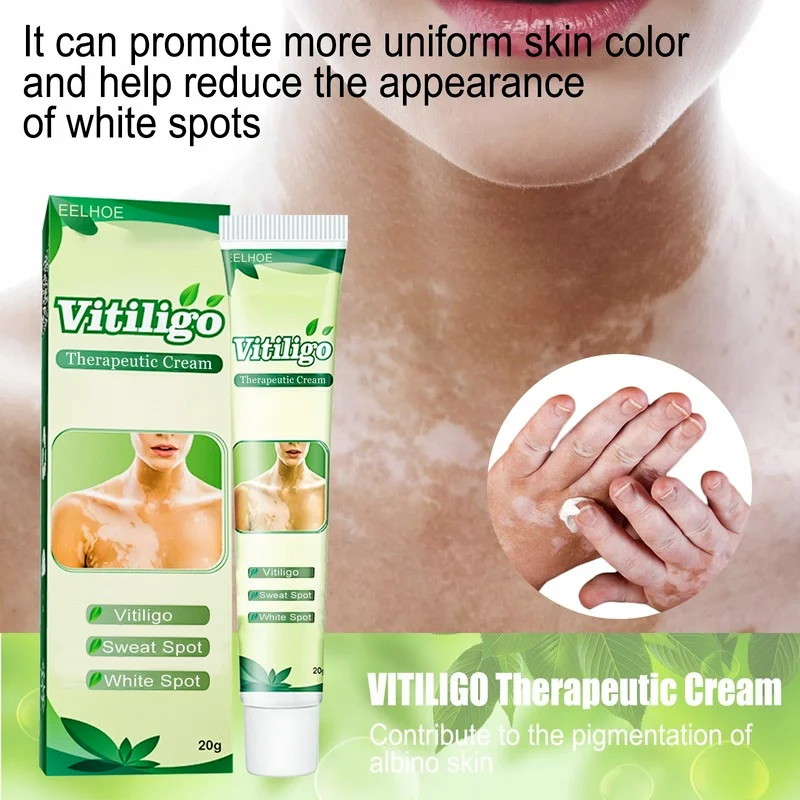 

Effective Treatment of White Spots Restoring Cream Skin Care Relief of Spots Topical Cream Body Skin Care Cream Whitening Cream