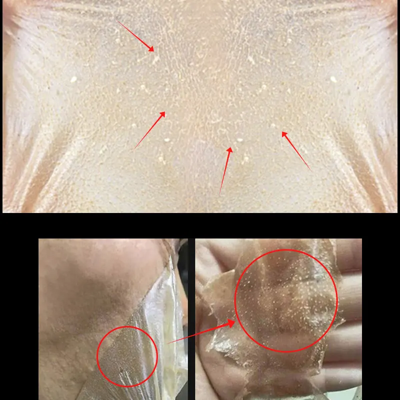 ARTISCARE минеральная грязь + средство для удаления угрей маска лица полоска пор