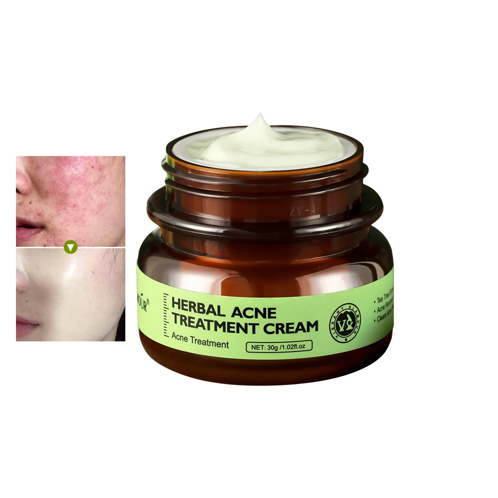 Крем для лечения акне увлажняющий крем контроля жирности Удаление прыщей и