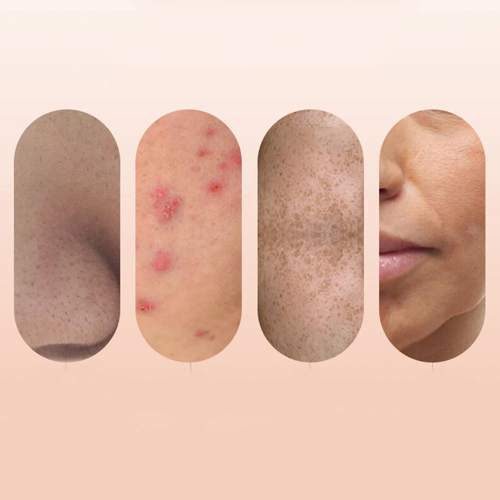 Очиститель пор глубокое очищение омертвевшей кожи средство для удаления угрей