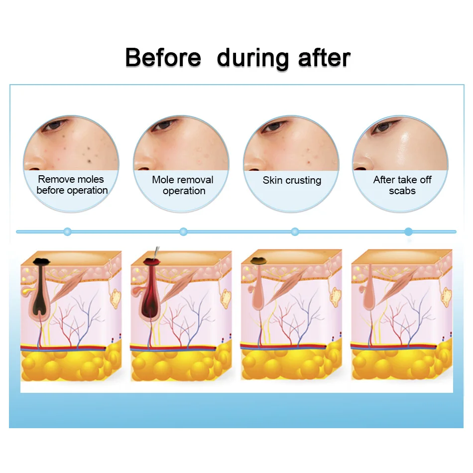Машинка для удаления татуировок с 9 уровнями лазерная плазменная ручка темных