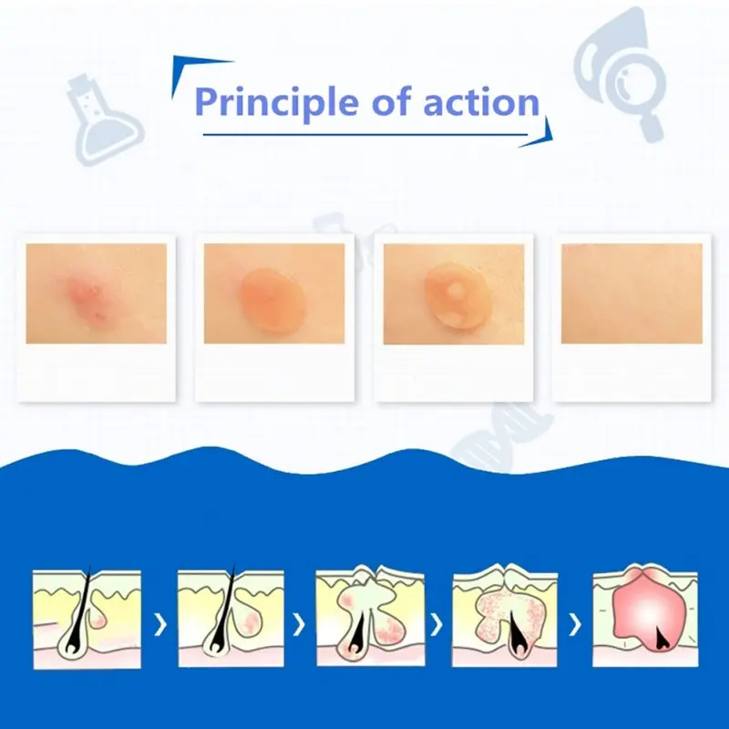 30 шт. патчи для ухода за кожей лица от веснушек и прыщей |