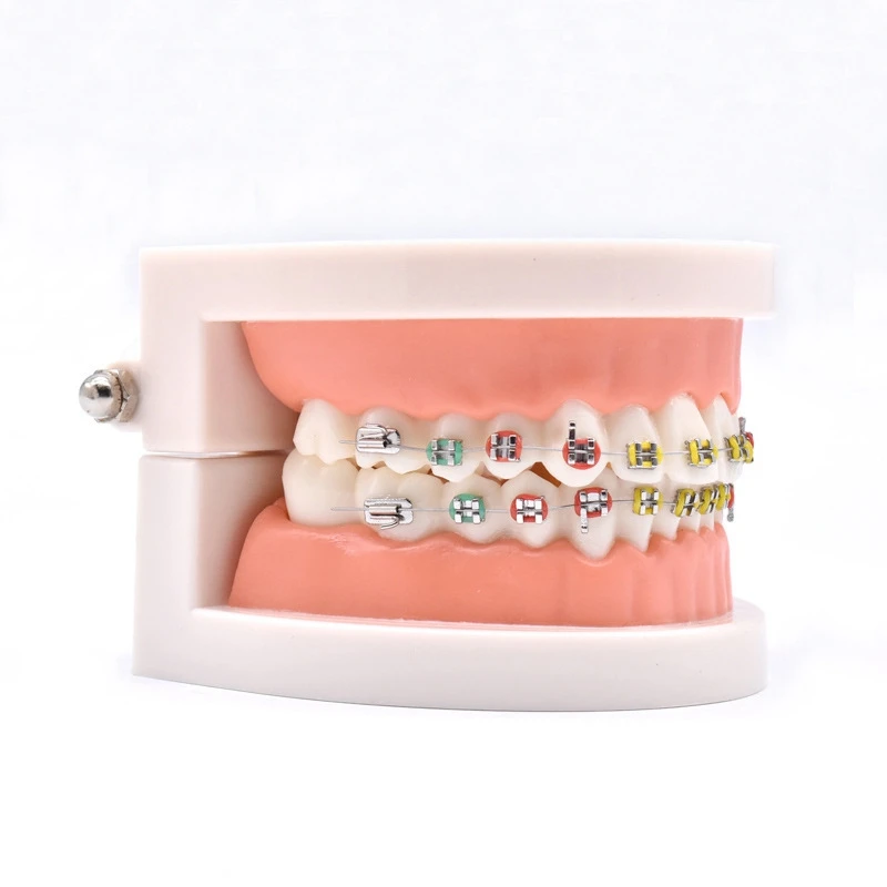 Ортодонтическая лечебная модель с ортодонтическим металлическим керамическим